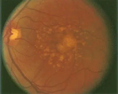 A close up of an eye with yellow spots