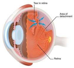 A diagram of an eye with the tear in it.